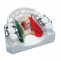 Kit dispozitiv distalizare rapida molar First-Class